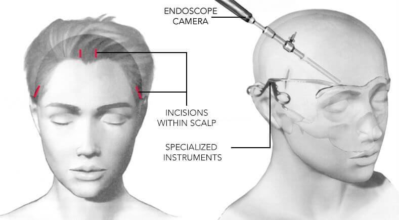 endoscopic brow lift.jpg